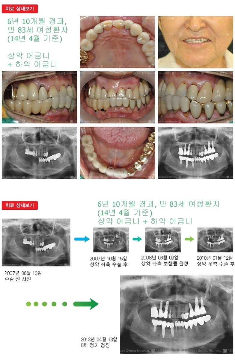 상악 어금니 하악 어금니 19년 3개월경과 — 추가 사진 (임플란트)