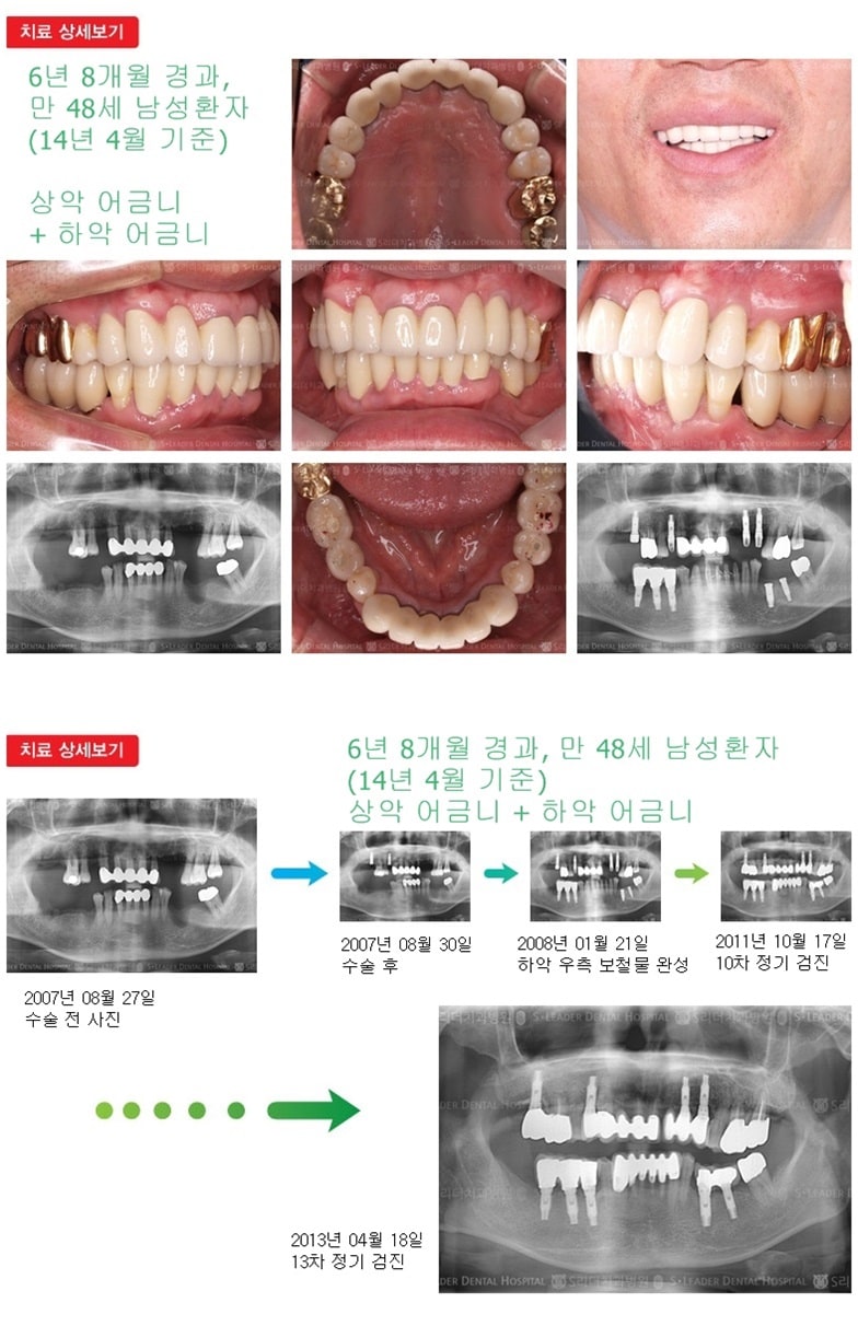 상악 어금니 +  하악 어금니 — 추가 사진 (임플란트)