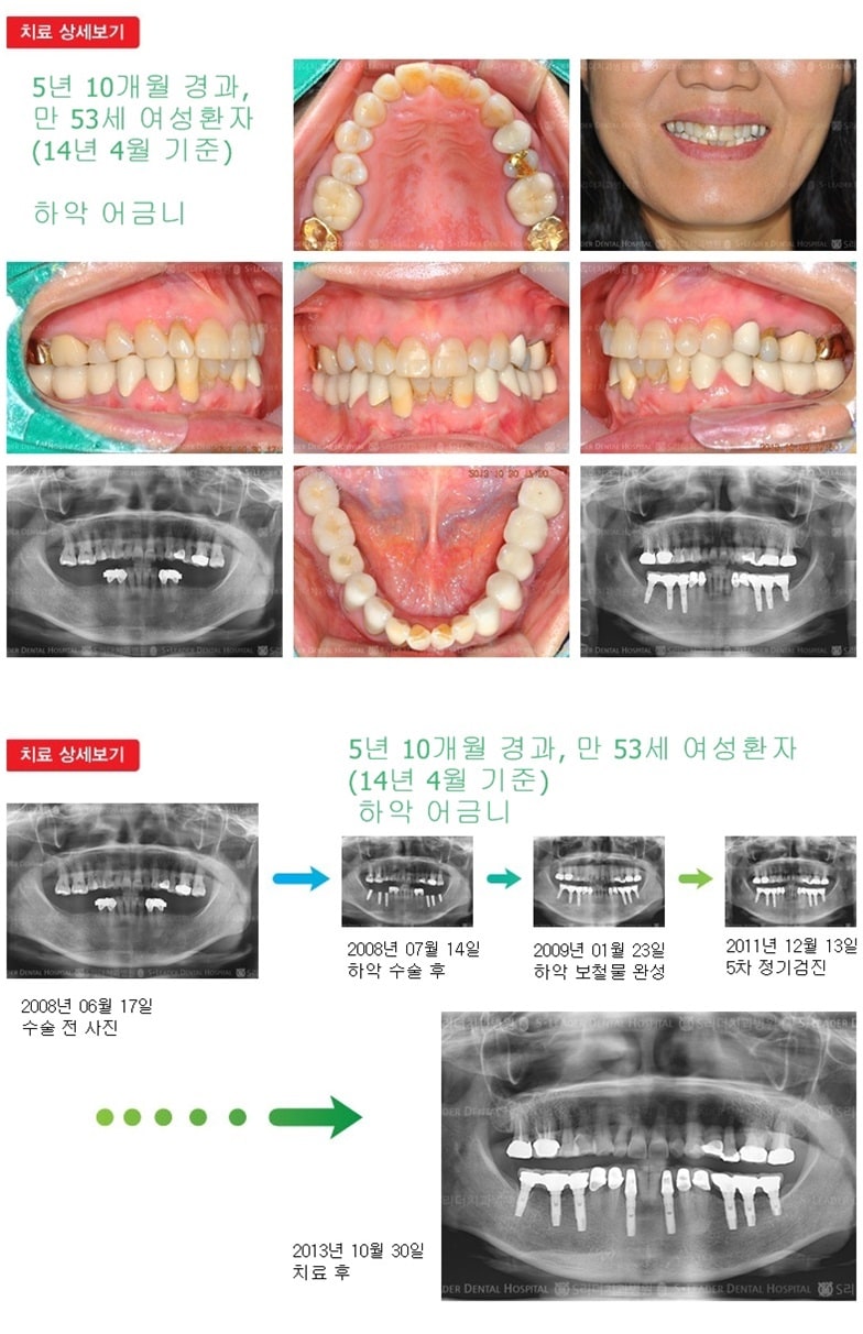 어금니임플란트, 18년 3개월 경과 — 추가 사진 (임플란트)