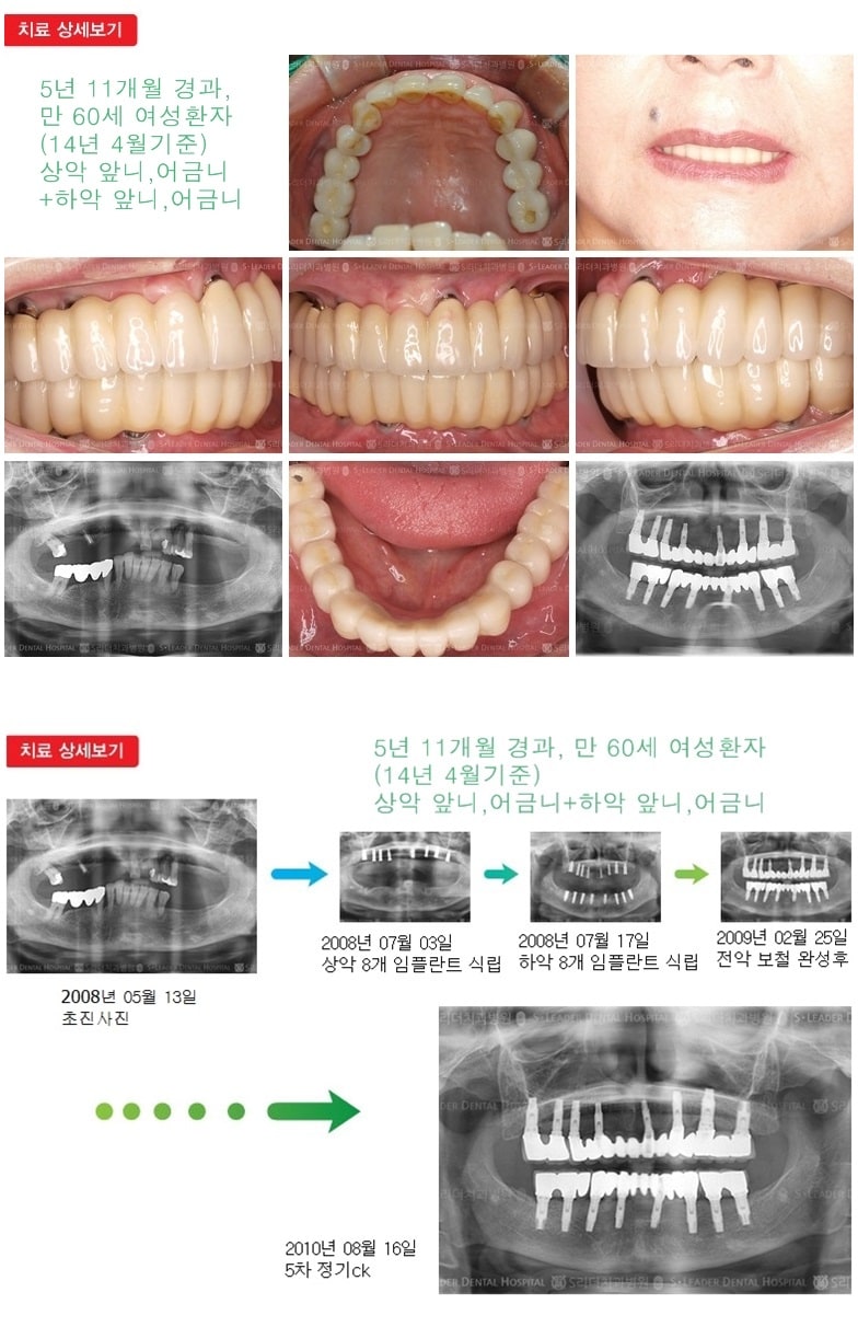상악 전체, 하악 전체 18년 4개월경과 — 추가 사진 (임플란트)