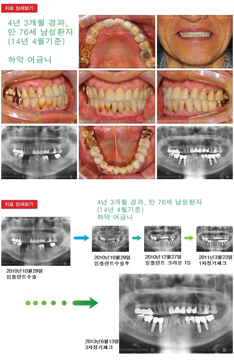 65세이상임플란트, 만 76세,16년 8개월경과 — 추가 사진 (임플란트)