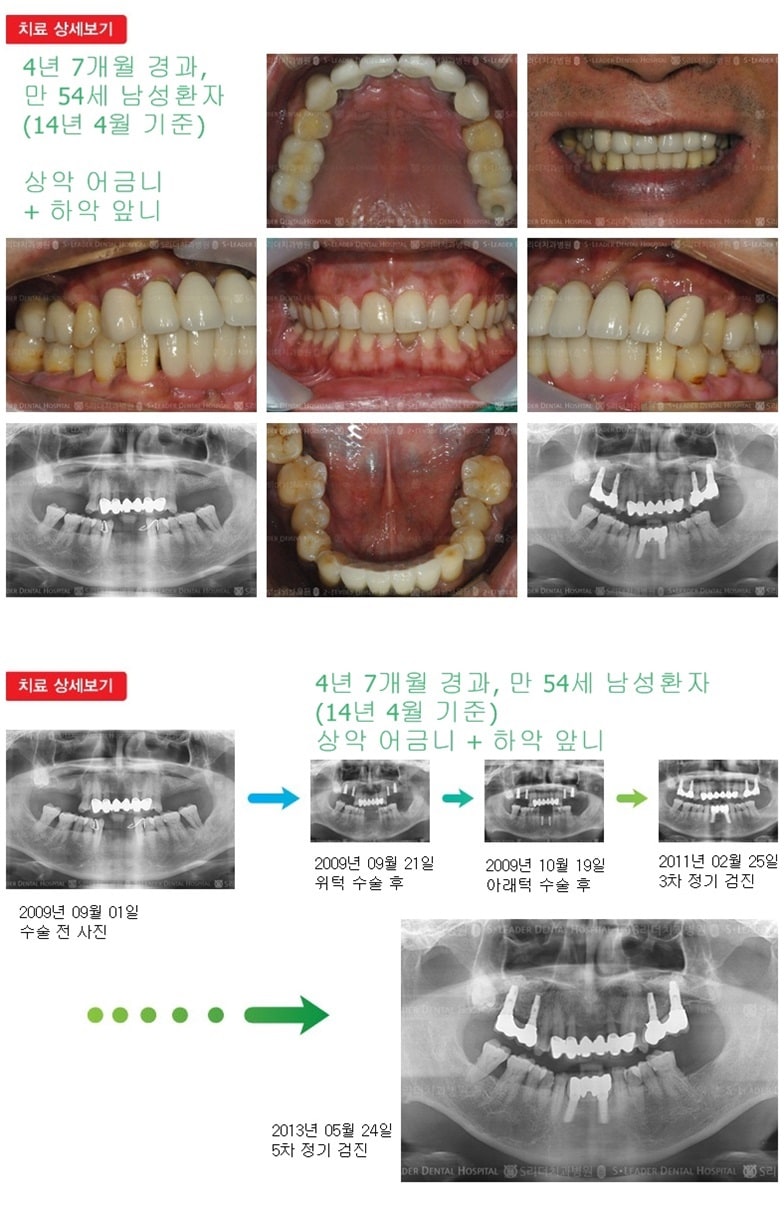 상악어금니,하악어금니,17년경과 — 추가 사진 (임플란트)