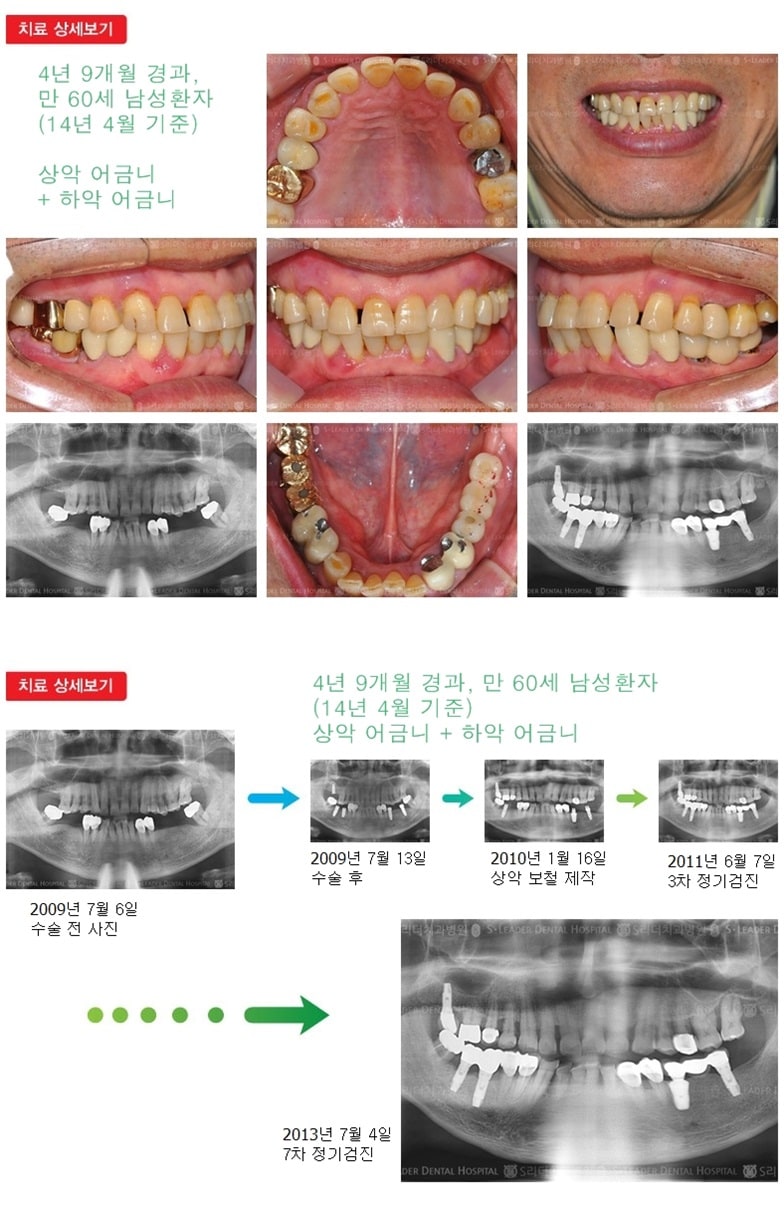 어금니임플란트, 17년 2개월 경과 — 추가 사진 (임플란트)