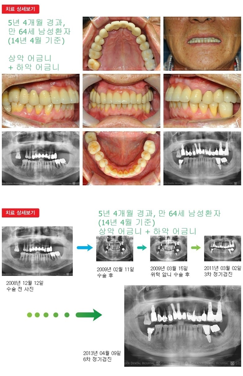 상악어금니,하악어금니,17년 9개월경과 — 추가 사진 (임플란트)