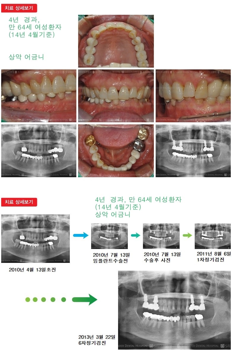 상악 어금니 +  하악 어금니 — 추가 사진 (임플란트)