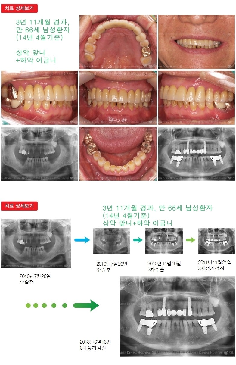 상악 어금니 +  하악 어금니 — 추가 사진 (임플란트)