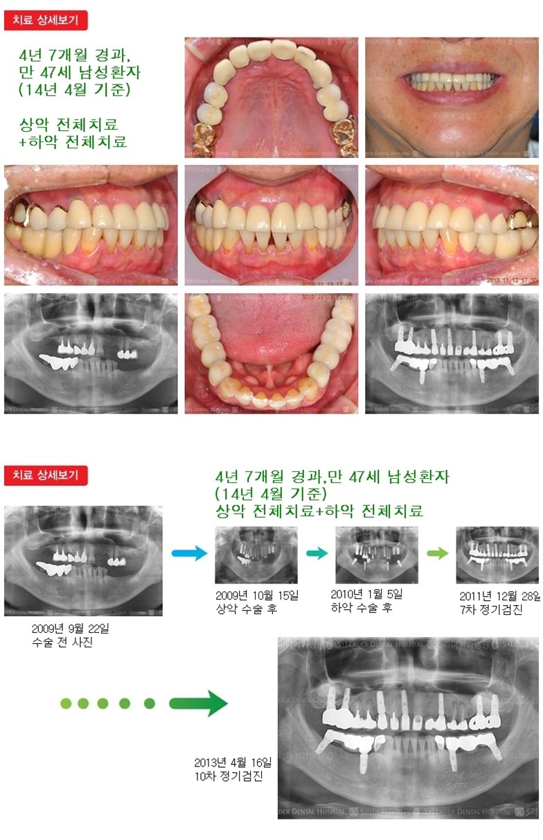 상악 전체,하악전체, 17년경과 — 추가 사진 (임플란트)