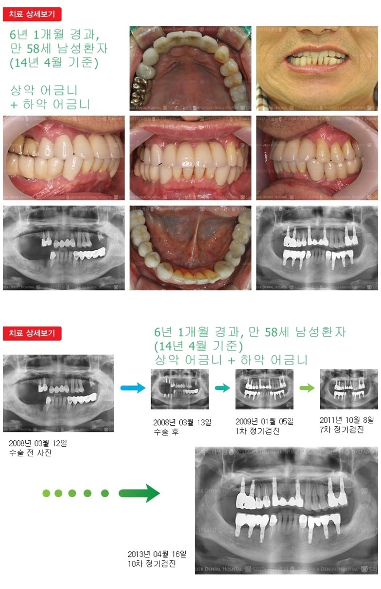 상악어금니,하악어금니,18년 6개월경과 — 추가 사진 (임플란트)
