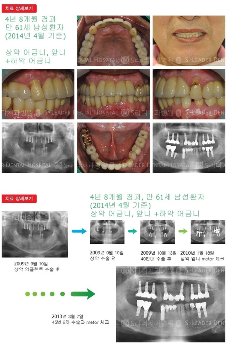 상악 전체, 하악 어금니 17년 1개월 경과 — 추가 사진 (임플란트)