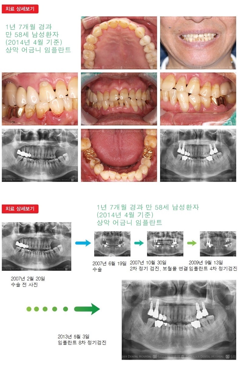 상악어금니,14년경과 — 추가 사진 (임플란트)