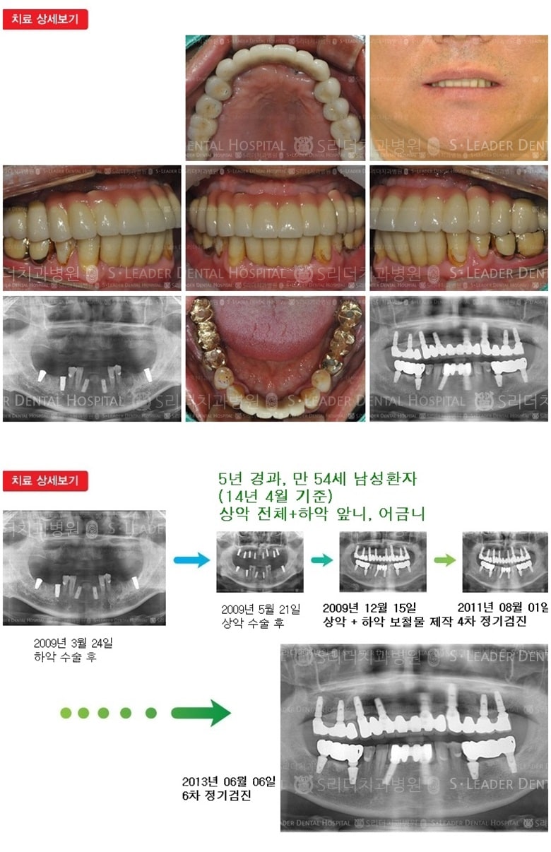 상악, 하악 전체치료 17년 5개월 경과 — 추가 사진 (임플란트)