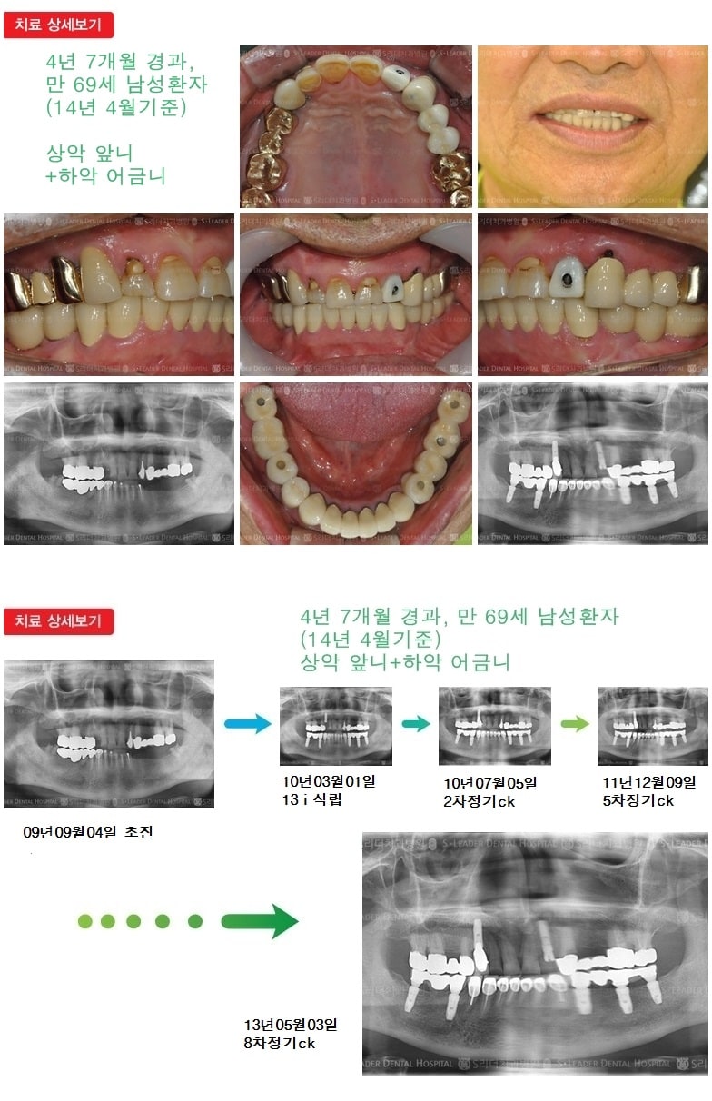 상악 어금니 +  하악 어금니 — 추가 사진 (임플란트)