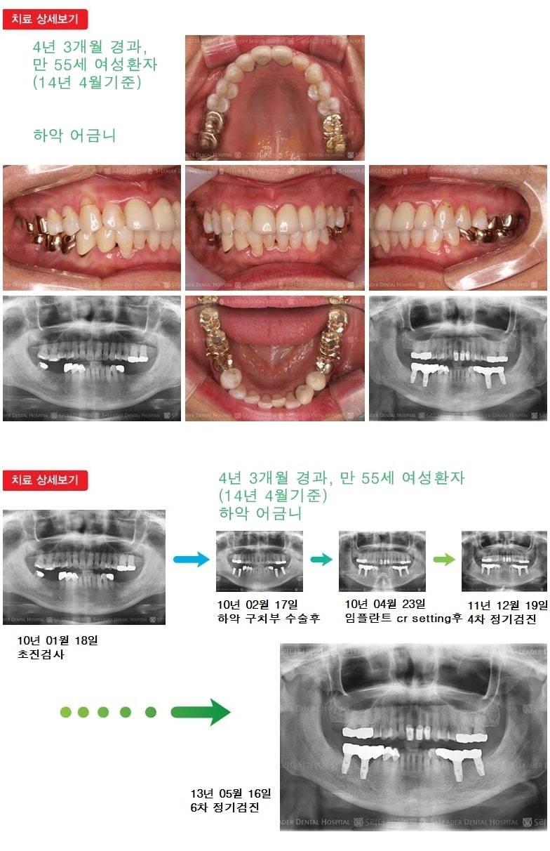 상악 어금니 +  하악 어금니 — 추가 사진 (임플란트)