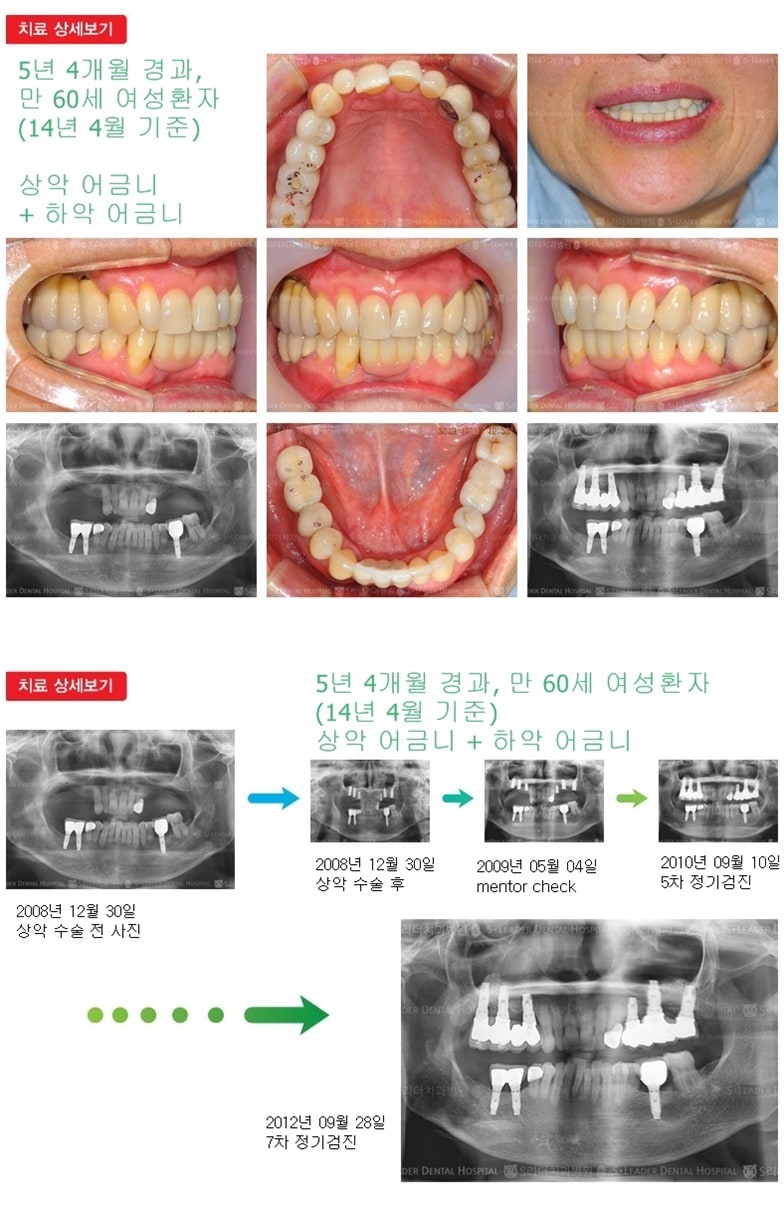 상악어금니,하악어금니,17년 9개월경과 — 추가 사진 (임플란트)