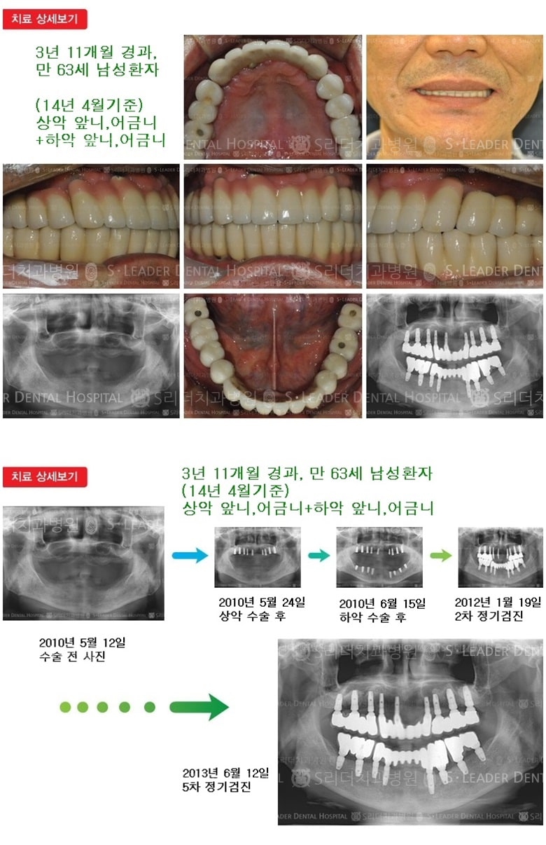 상악, 하악 전체치료 — 추가 사진 (임플란트)