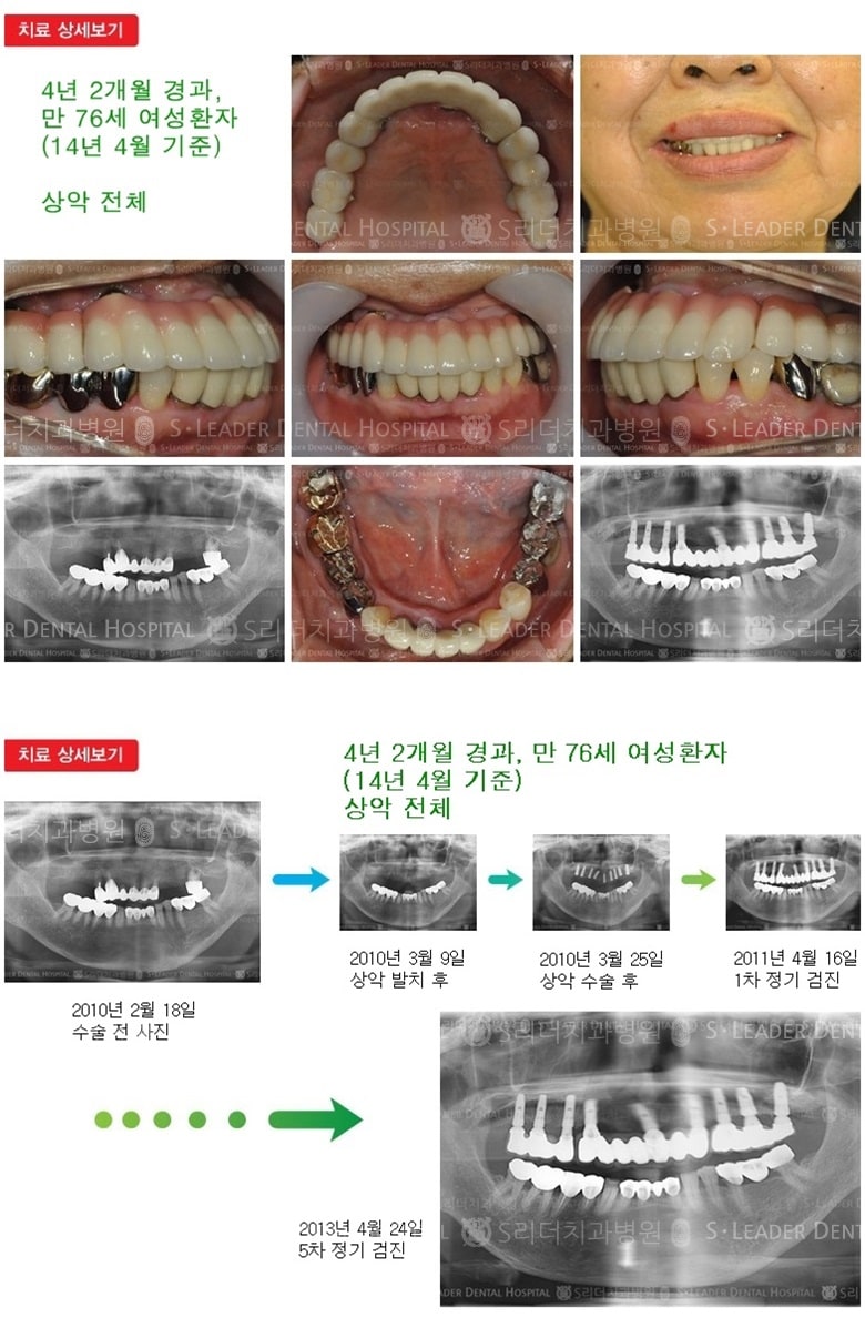 전체임플란트, 16년 7개월 경과 — 추가 사진 (임플란트)