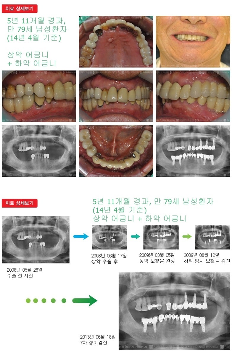 상악어금니,하악어금니,18년 4개월경과 — 추가 사진 (임플란트)