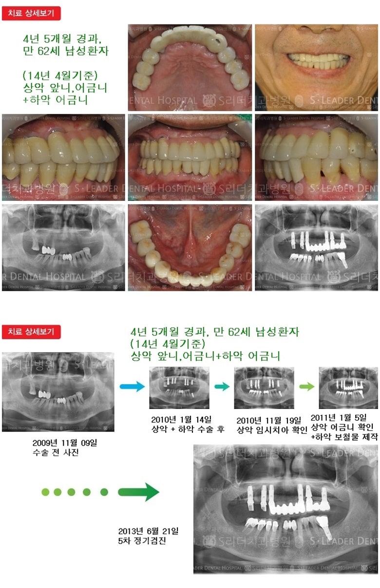 전체임플란트,어금니임플란트,16년 10개월경과 — 추가 사진 (임플란트)