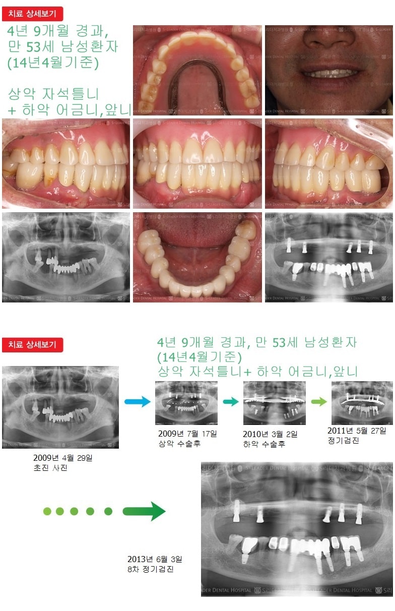 상악 자석틀니, 하악 어금니,앞니 — 추가 사진 (임플란트)