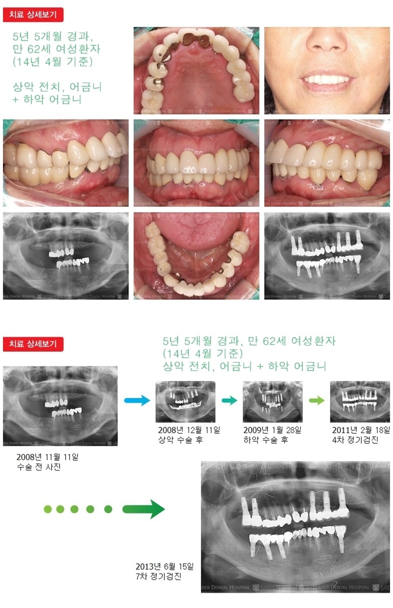 어금니임플란트, 17년 10개월 경과 — 추가 사진 (임플란트)