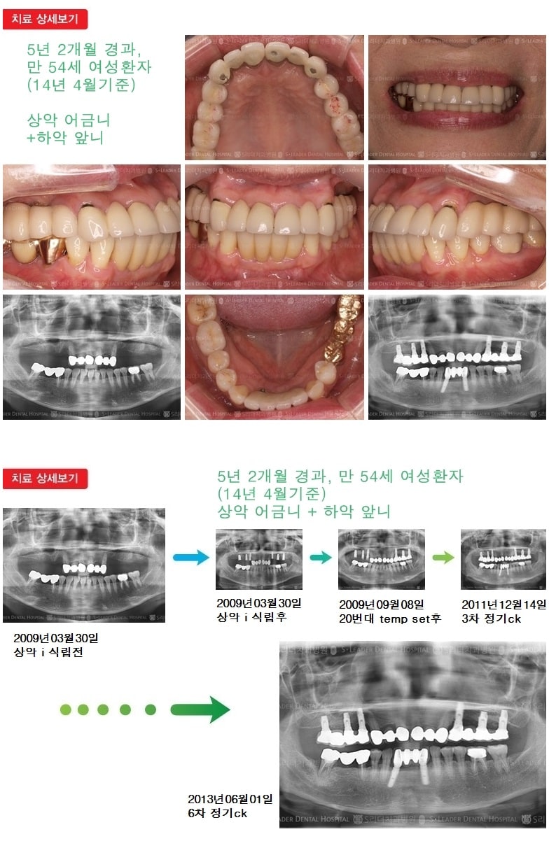 상악 어금니 +  하악 어금니 — 추가 사진 (임플란트)