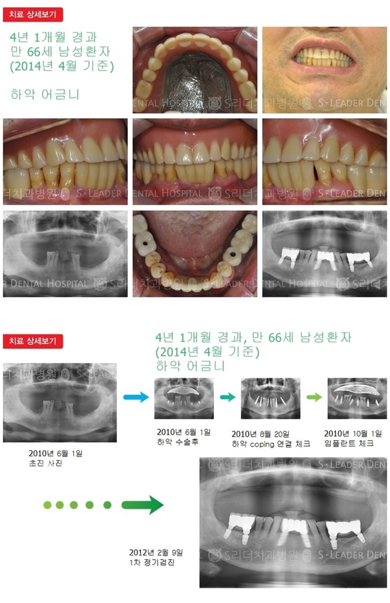 상악 틀니, 하악앞니,어금니 16년 6개월경과 — 추가 사진 (임플란트)