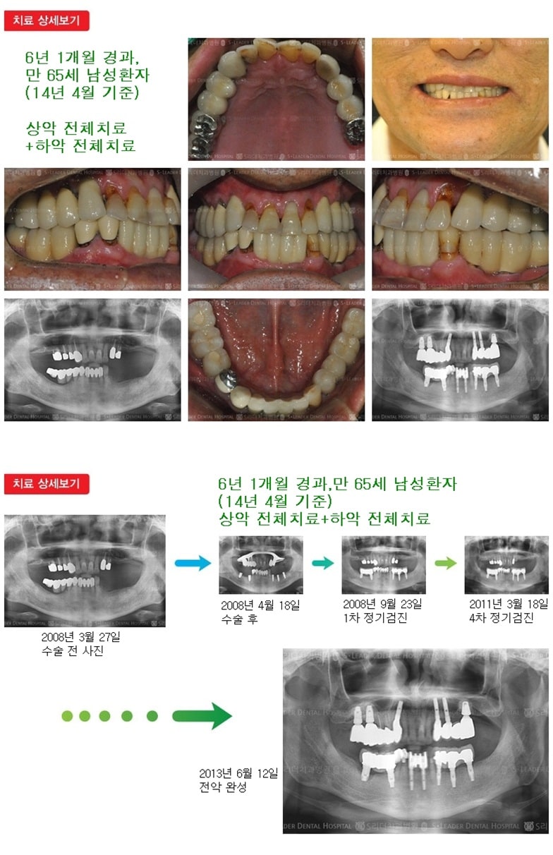 상악 전체,하악전체, 18년 6개월경과 — 추가 사진 (임플란트)