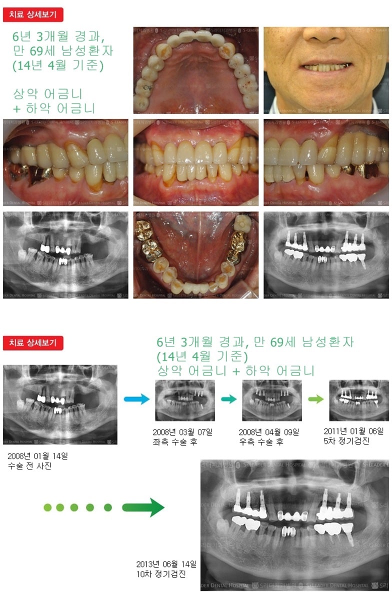 상악어금니,하악어금니,18년 8개월경과 — 추가 사진 (임플란트)