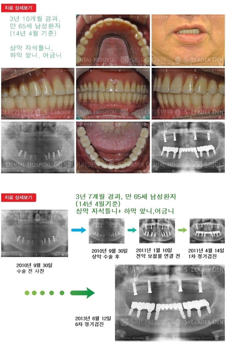 상악, 하악 전체치료 — 추가 사진 (임플란트)