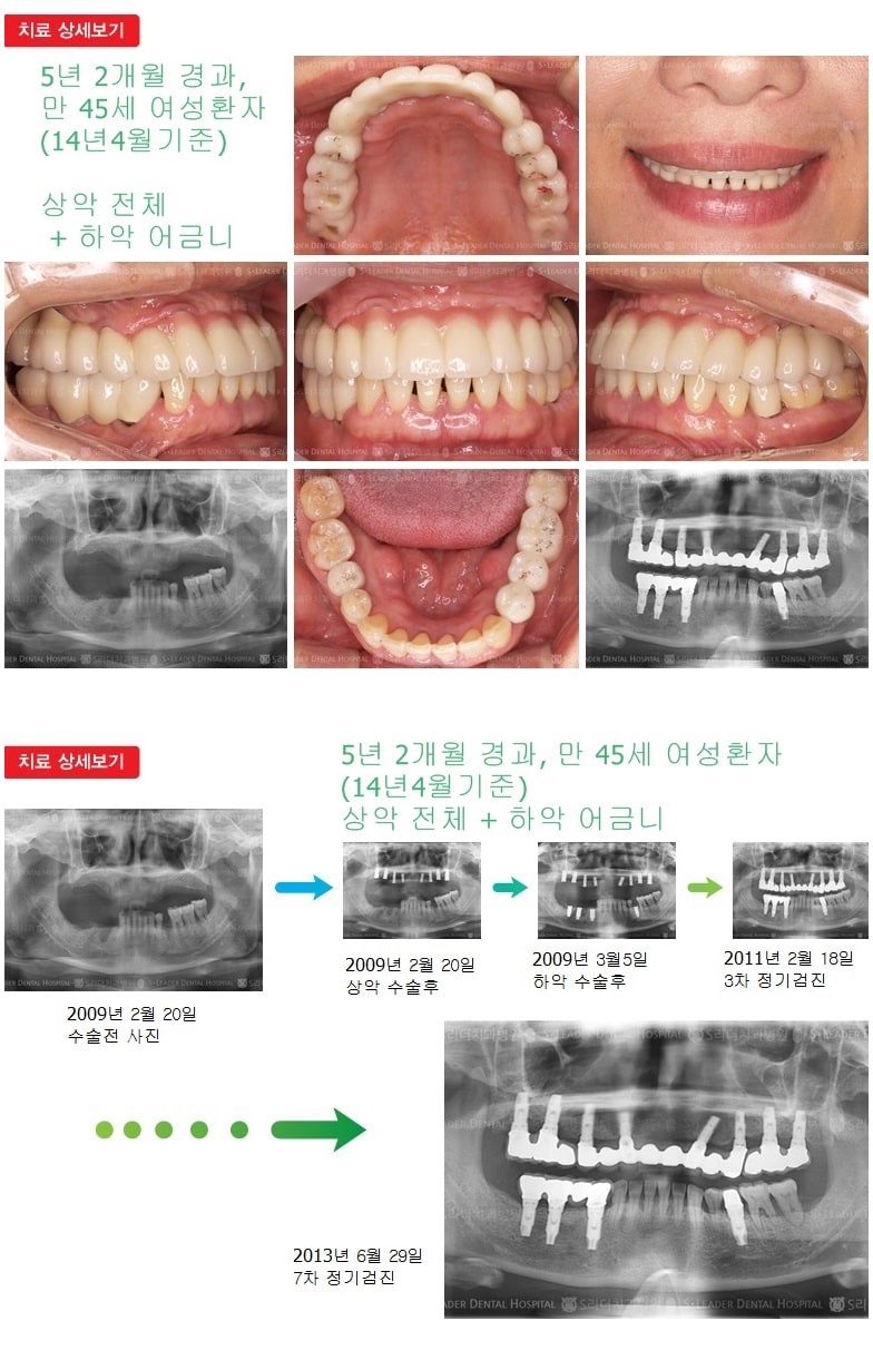 상악 어금니 +  하악 어금니 — 추가 사진 (임플란트)