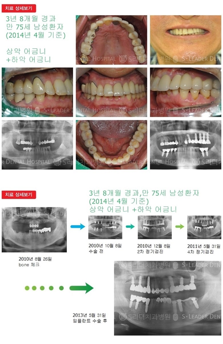 하악 어금니, 상악 어금니,16년 1개월 경과 — 추가 사진 (임플란트)