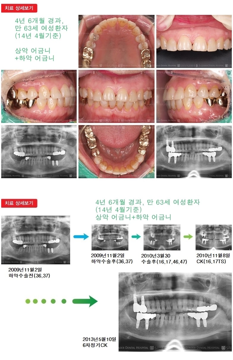 상악 어금니 +  하악 어금니 — 추가 사진 (임플란트)