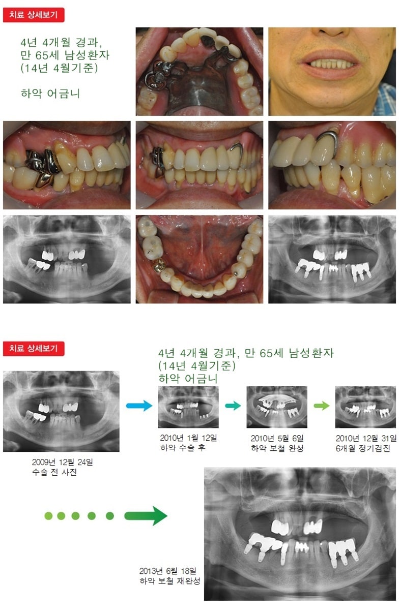 하악 어금니, 16년 9개월 경과 — 추가 사진 (임플란트)