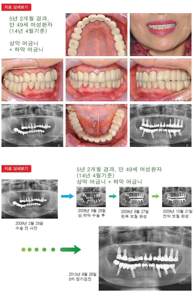 17년 7개월 경과, 상악 어금니+하악 어금니 — 추가 사진 (임플란트)