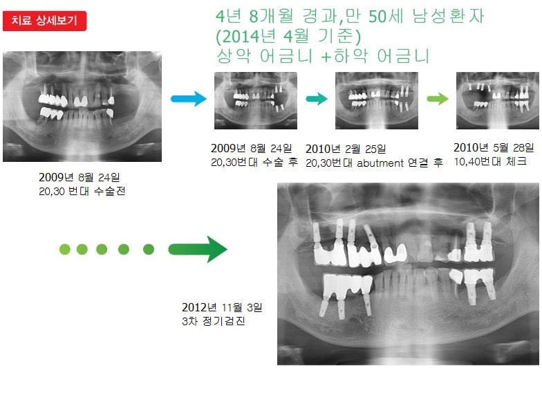 상악어금니,하악어금니,17년 1개월 경과 — 추가 사진 (임플란트)