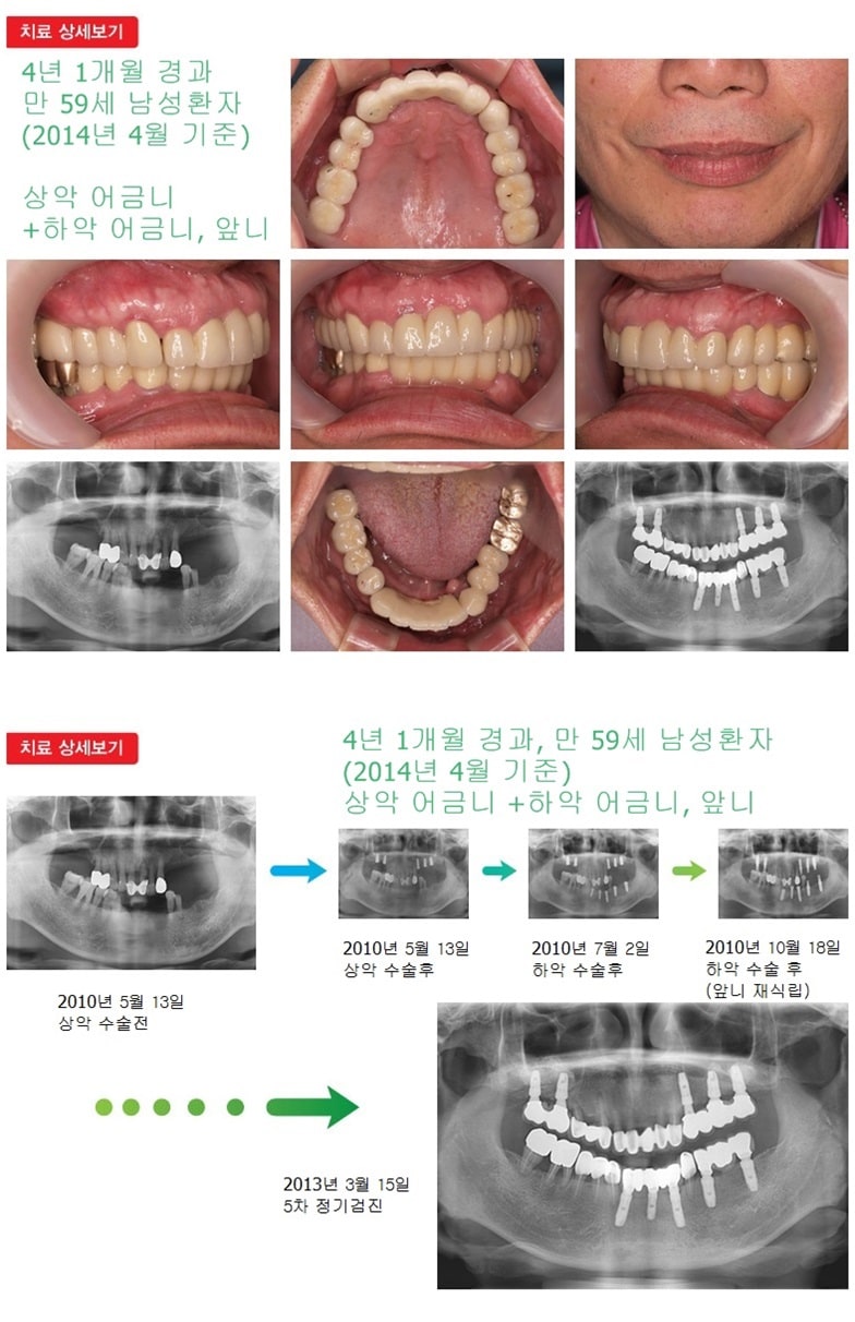 상악어금니,하악어금니,앞니,16년 6개월경과 — 추가 사진 (임플란트)