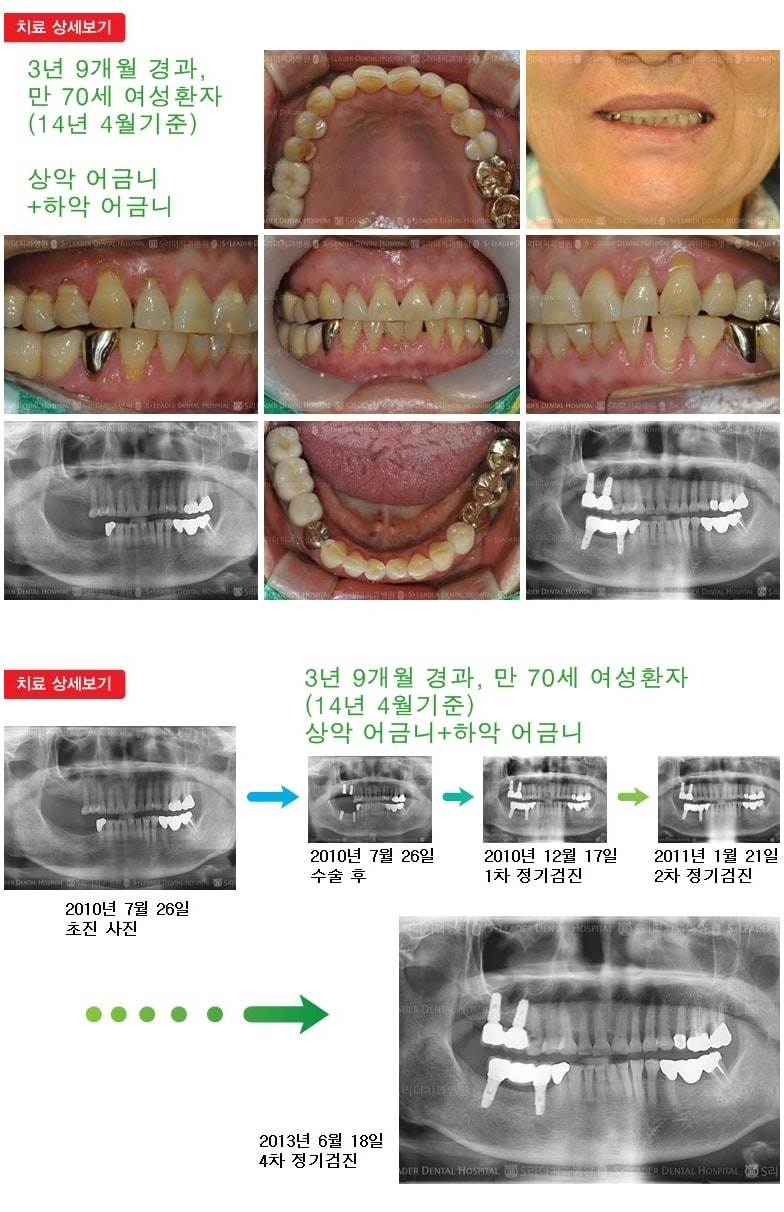 65세이상임플란트,만70세,16년 2개월 경과 — 추가 사진 (임플란트)