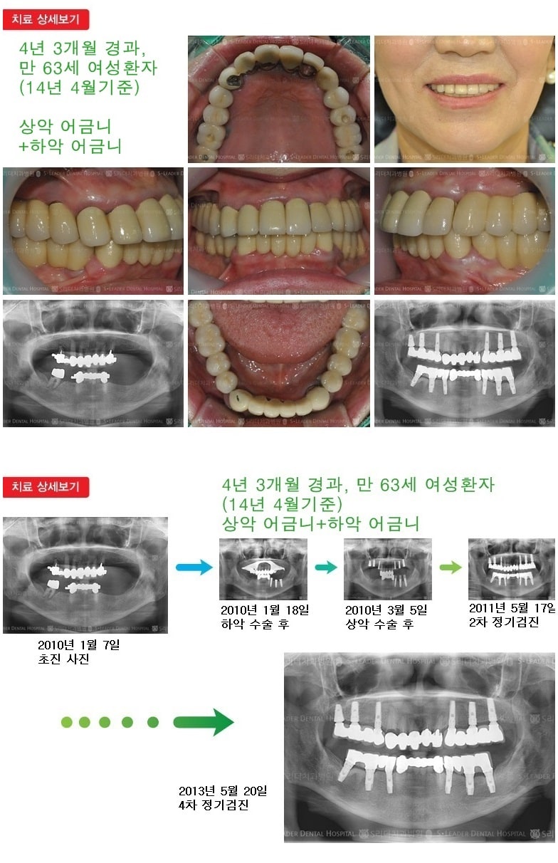 상악어금니,하악어금니,16년 8개월 경과 — 추가 사진 (임플란트)