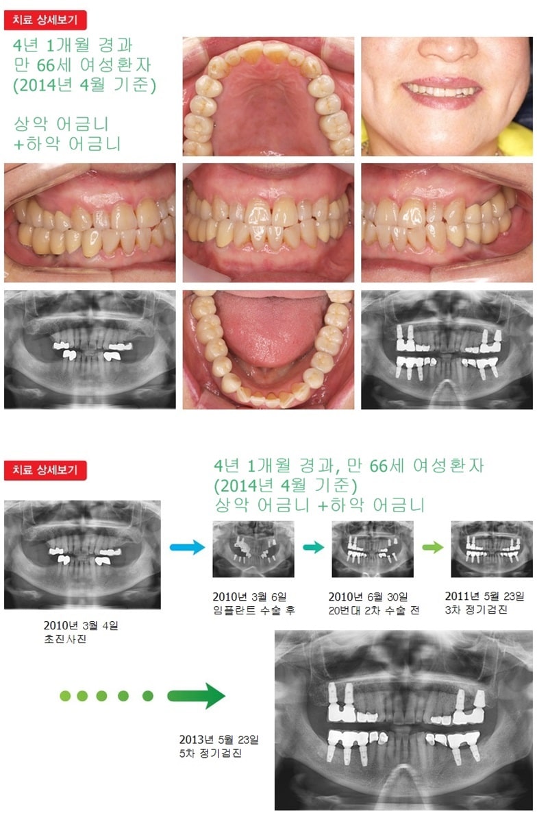 상악어금니,하악어금니,16년 6개월경과 — 추가 사진 (임플란트)