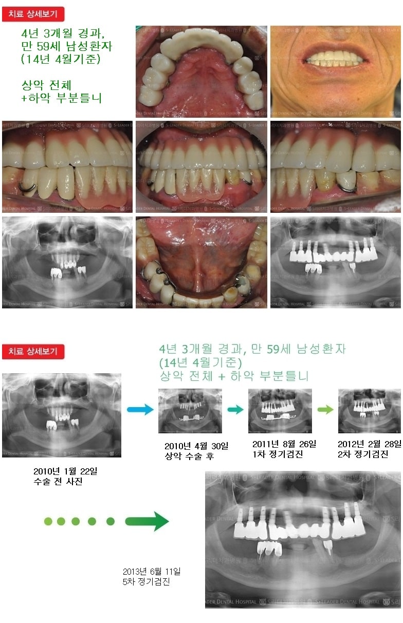 상악전체,하악부분틀니,16년 8개월 경과 — 추가 사진 (임플란트)