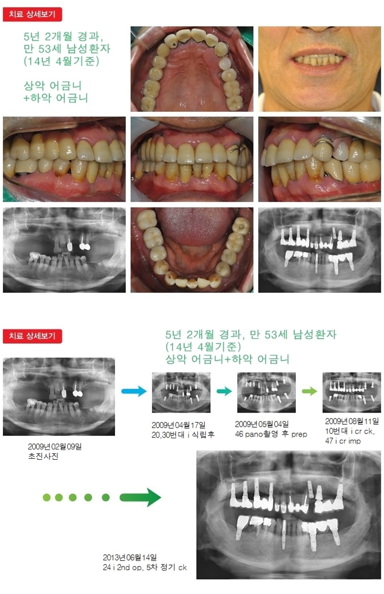 상악어금니,하악어금니,17년 7개월경과 — 추가 사진 (임플란트)