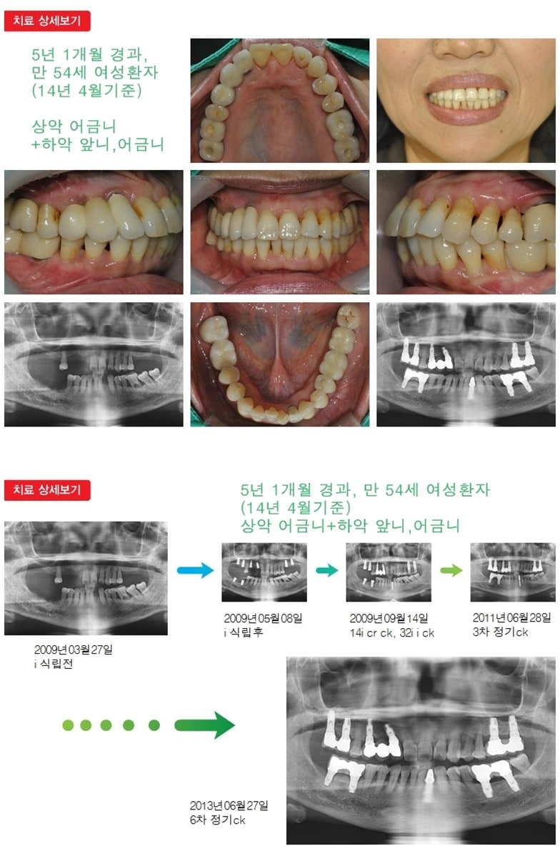 상악 어금니,하악앞니어금니,17년 6개월 경과 — 추가 사진 (임플란트)
