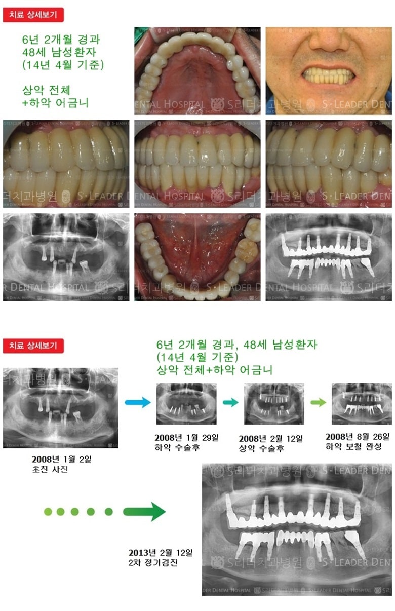 상악 전체,하악 어금니, 18년 7개월 경과 — 추가 사진 (임플란트)