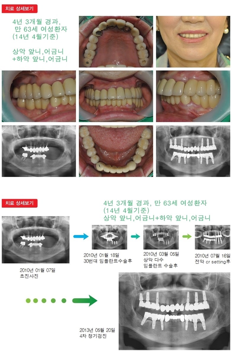 상악 앞니어금니,하악앞니 어금니,16년 8개월 — 추가 사진 (임플란트)