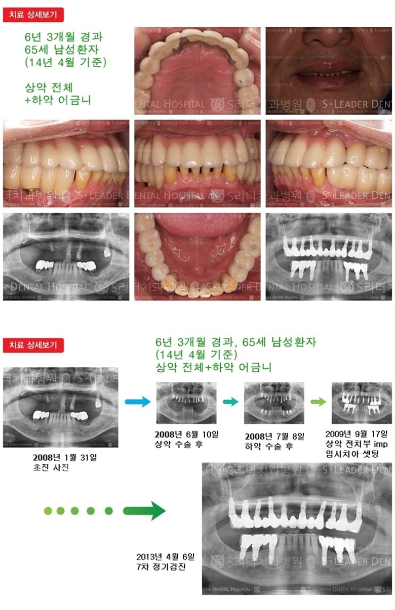 상악 전체,하악 어금니, 18년 8개월 경과 — 추가 사진 (임플란트)