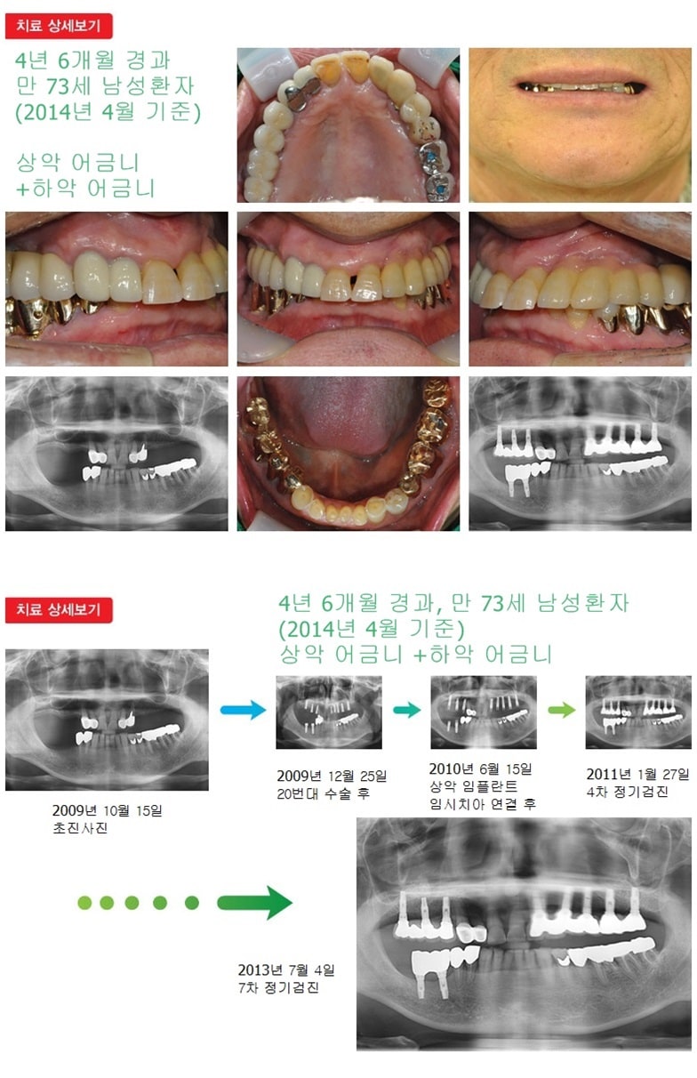 상악어금니,하악어금니,16년 11개월경과 — 추가 사진 (임플란트)