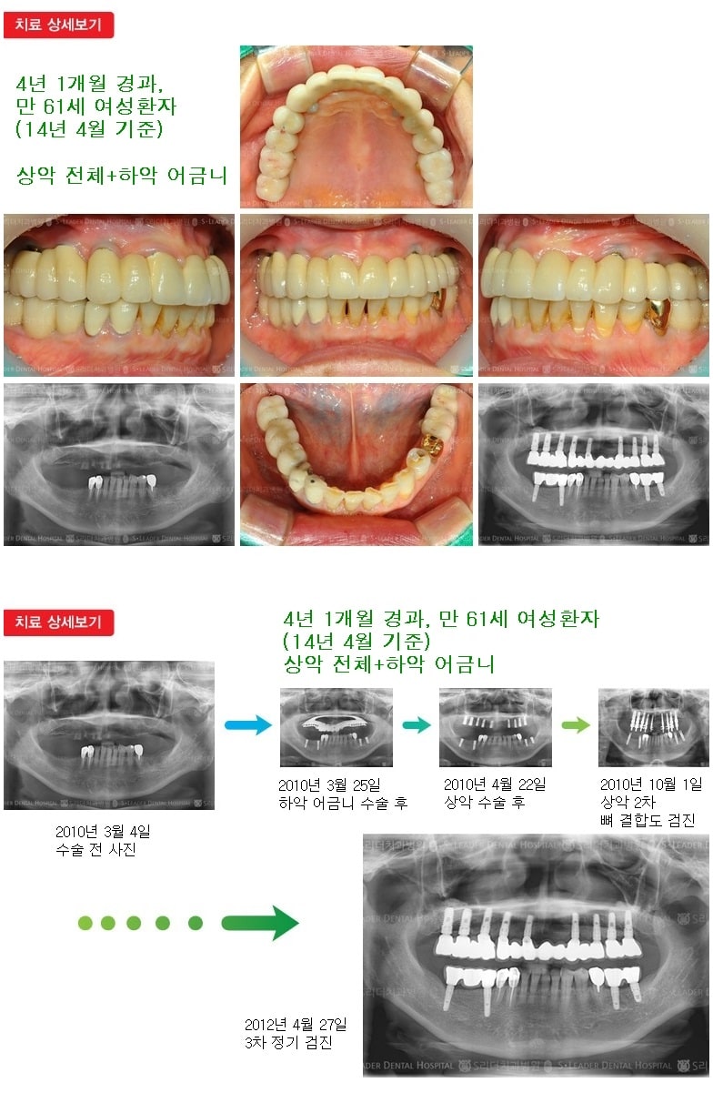 상악전체,하악어금니,16년 6개월 경과 — 추가 사진 (임플란트)