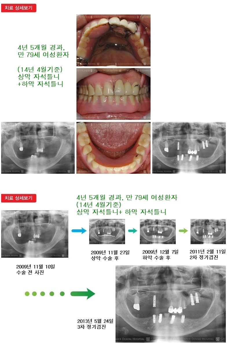 상악 자석틀니, 하악 자석틀니,16년 10개월 — 추가 사진 (임플란트)