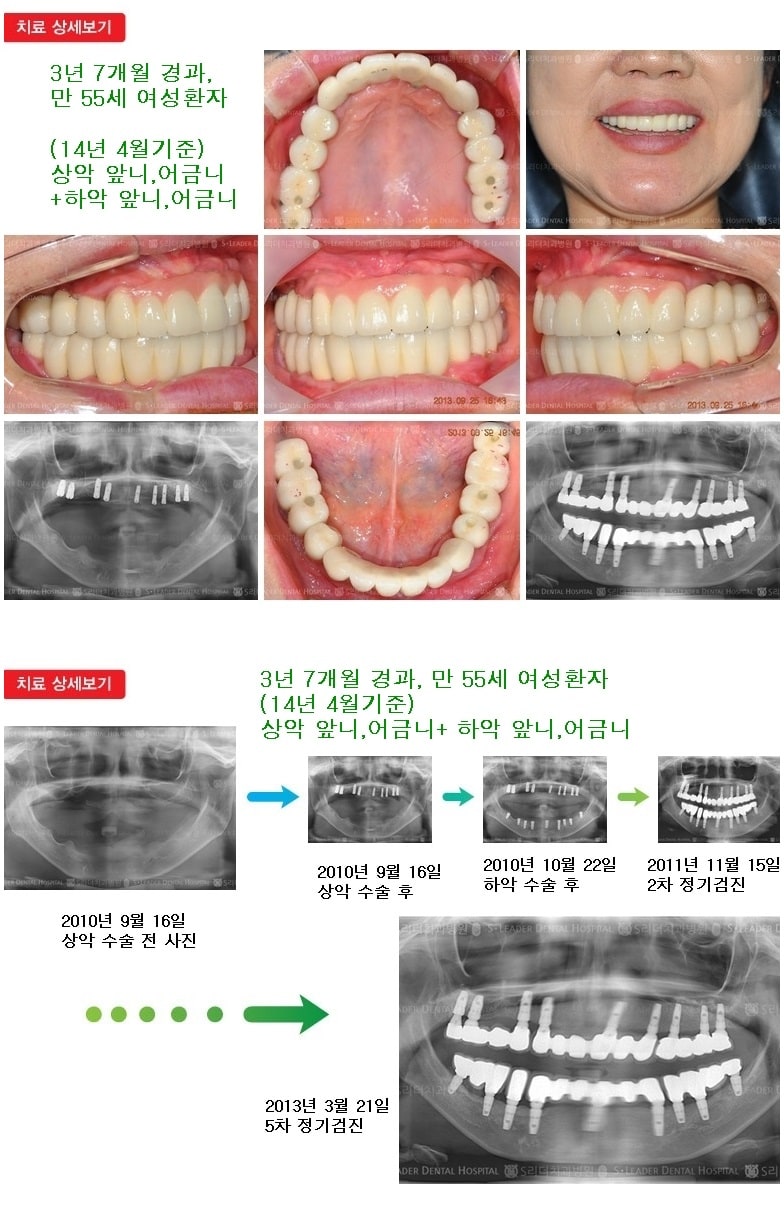 상악앞니.어금니,하악앞니,16년경과 — 추가 사진 (임플란트)