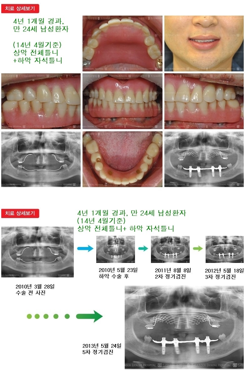 상악 전체틀니, 하악 자석틀니16년 6개월 경과 — 추가 사진 (임플란트)